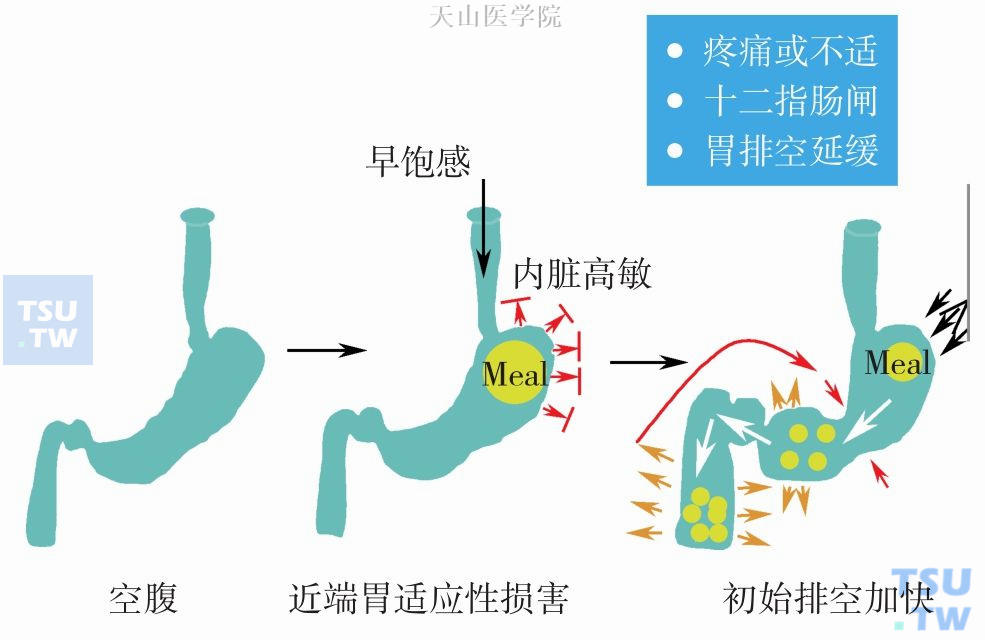 餐后上腹痛及早饱感