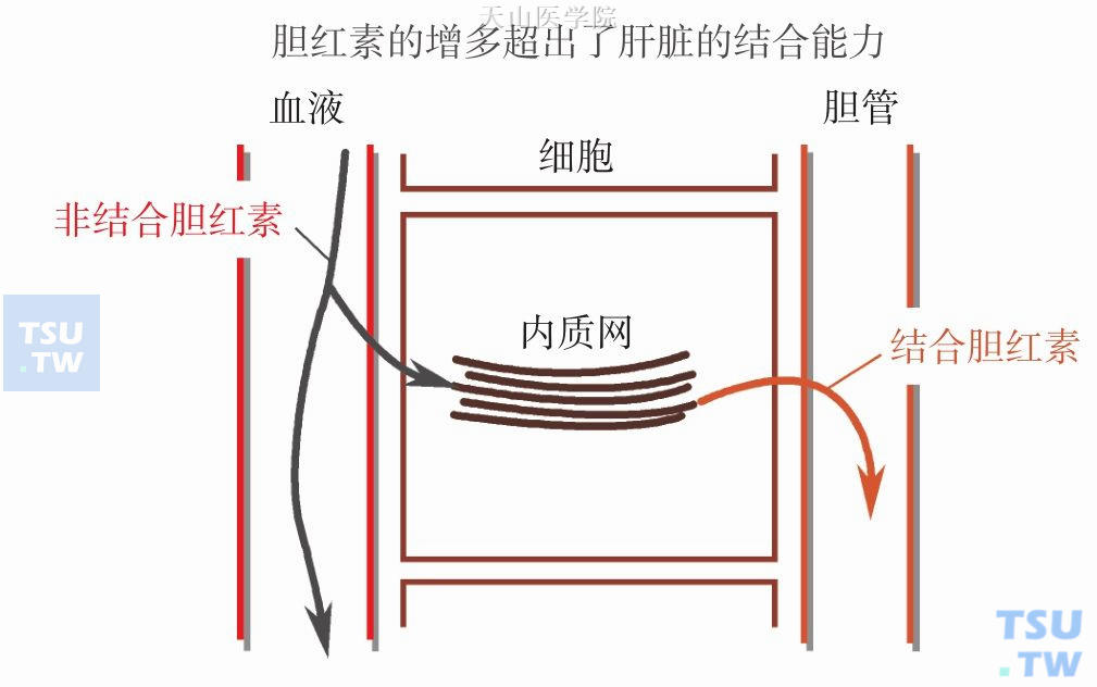 溶血性黄疸机制图