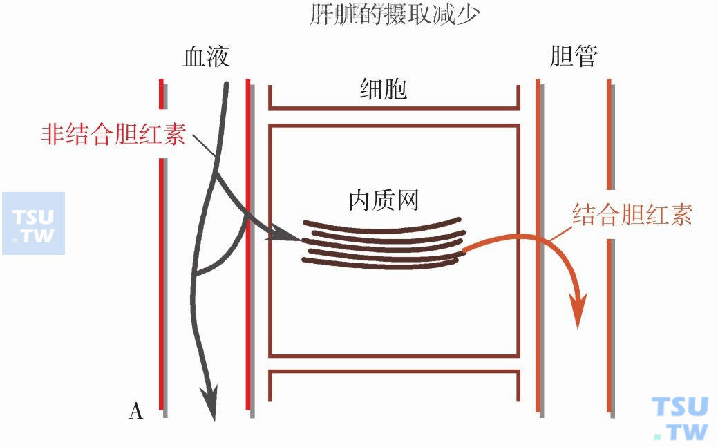 肿瘤引起胆汁淤积性黄疸主要见于