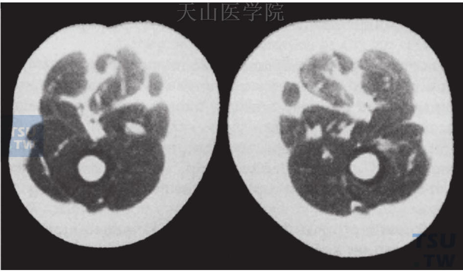 不同年龄妇女大腿肌肉与脂肪含量的比较