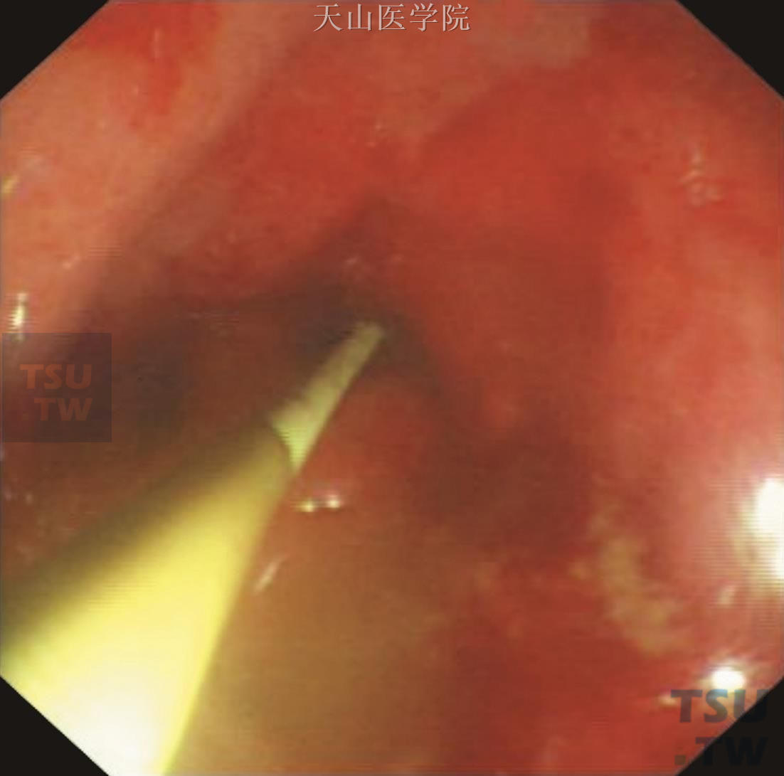 胃镜下长导管置入小肠内（照片提供：吉林大学第一医院内镜中心）