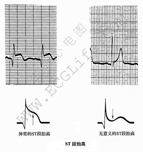 波的形态：ST段及ST段抬高与下降图解