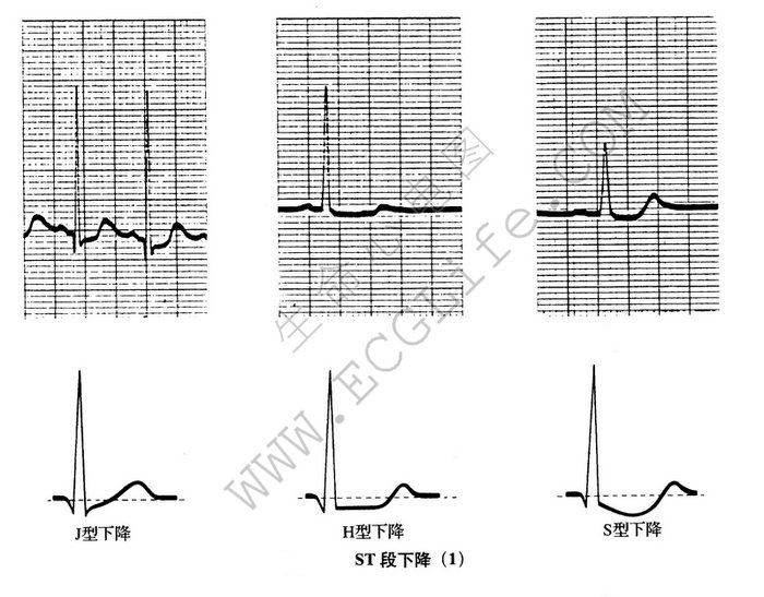 st压低心电图示意图图片