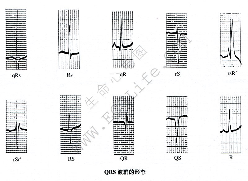 波的形态：QRS波群代表的意义