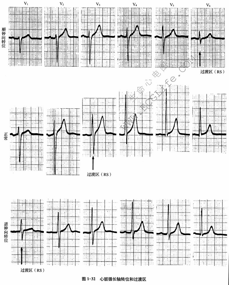 心脏顺钟向转位心电图图片