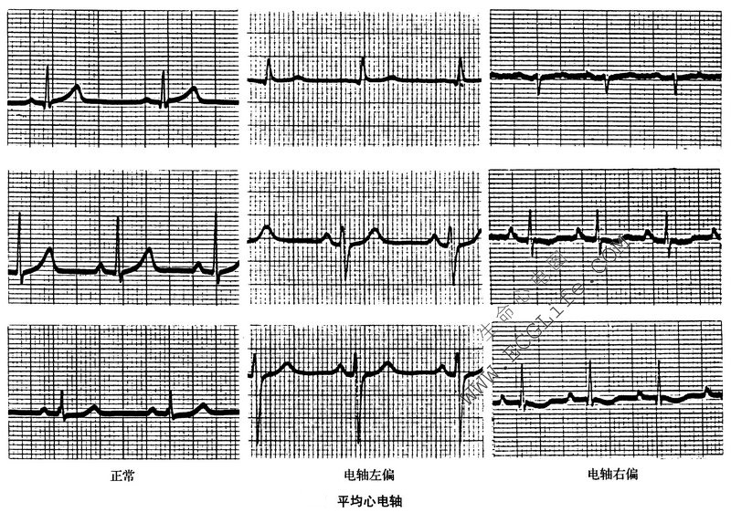 心电电轴图片