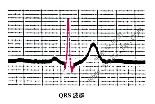 QRS波群