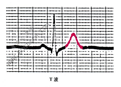 T波