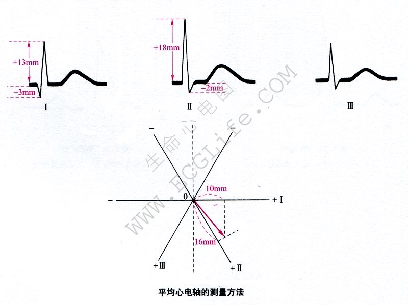 平均心电轴的测量方法