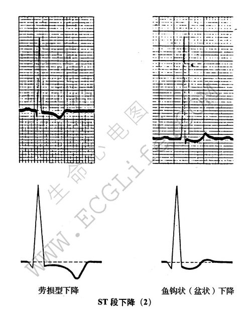 ST段下降