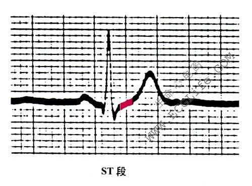 心电图ST段