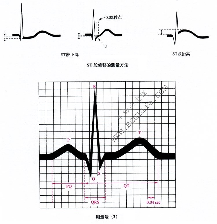 ST段偏移的测量方法