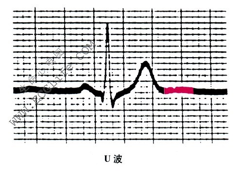 心电图u波明显图片