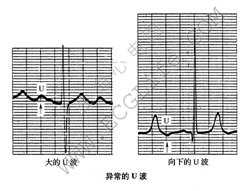 异常的U波