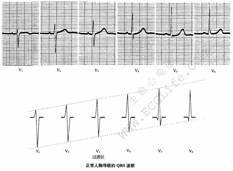 正常人胸导联的QRS波群