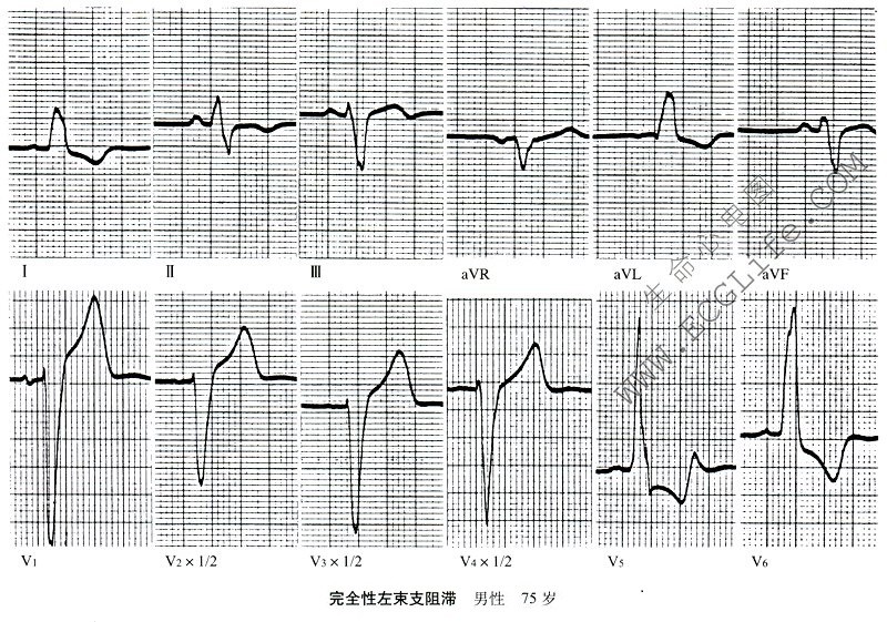 完全性左束支阻滞（心电图）