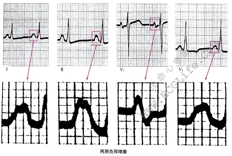 两房负荷增重（BAO）心电图表现