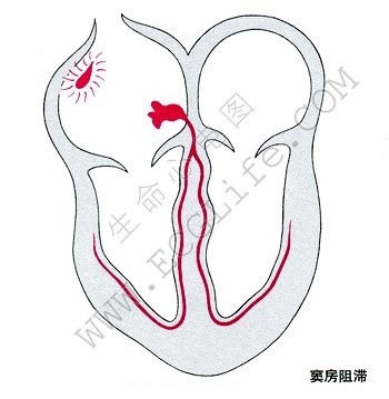 窦房阻滞示意图