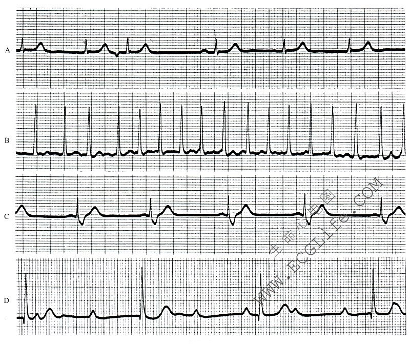 心律失常的心电图表现