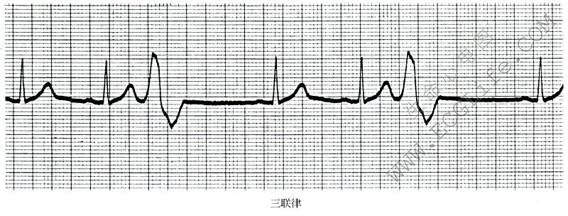 三联律期前收缩心电图