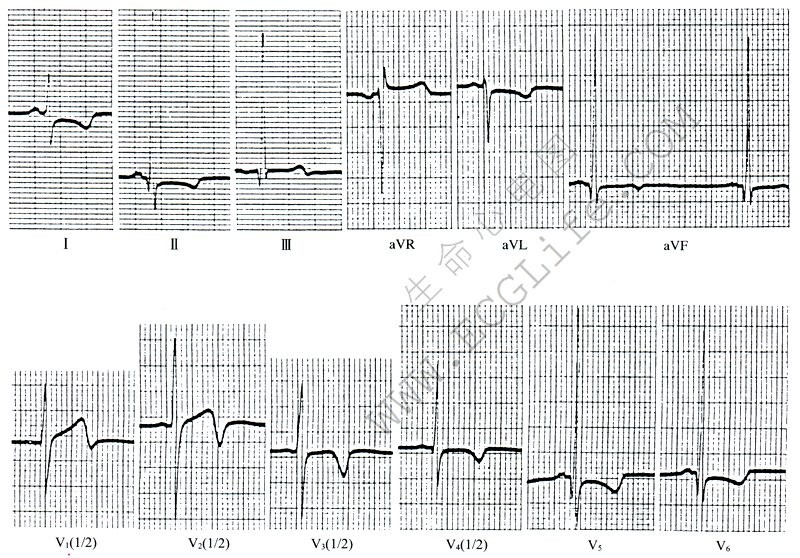 两侧心室肥大心电图