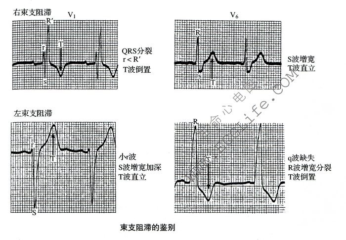 束支阻滞的鉴别（心电图）