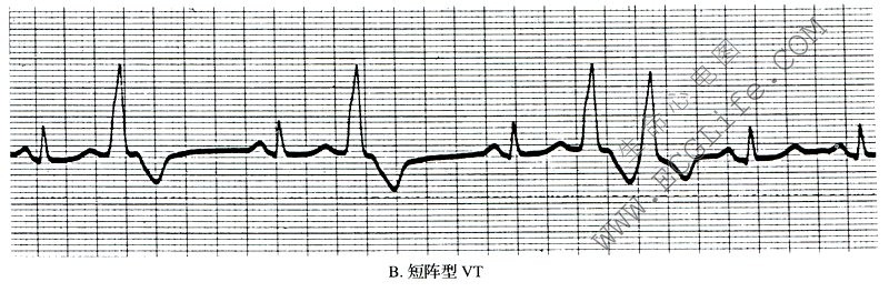 短阵型VT（心电图）