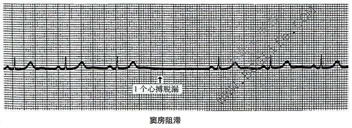 窦房阻滞心电图表现