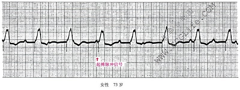 起搏心电图