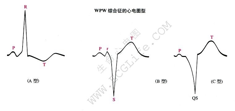 WPW综合征的心电图型