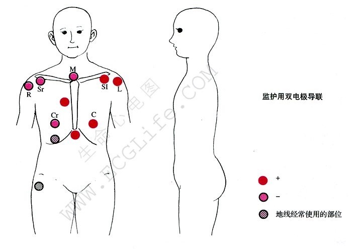 心电监护用双电极导联人体示意图