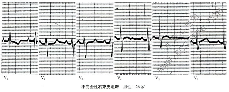 不完全性右束支阻滞心电图（导联2）