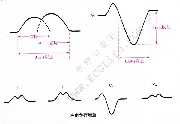 左房负荷增重心电图