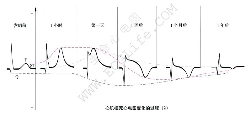 心肌梗死心电图变化过程（2）