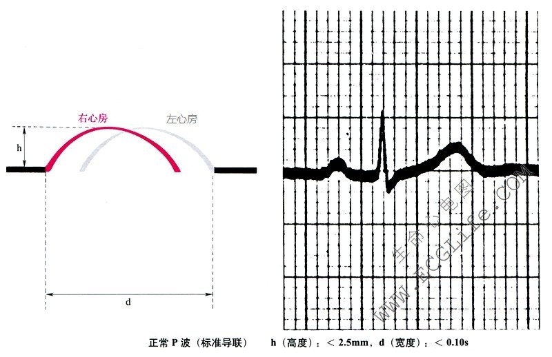 正常心电图P波（标准导联）