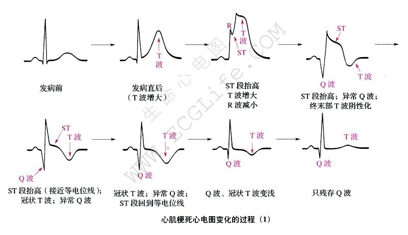 心肌梗死心电图变化的过程（1）