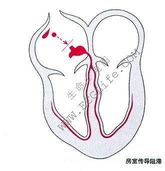 房室传导阻滞（AV block）