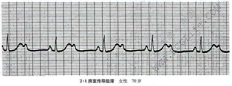 2:1房室传导阻滞心电图