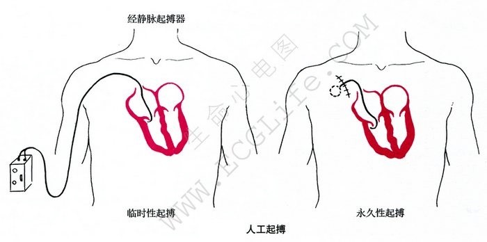 人工起搏和心电图