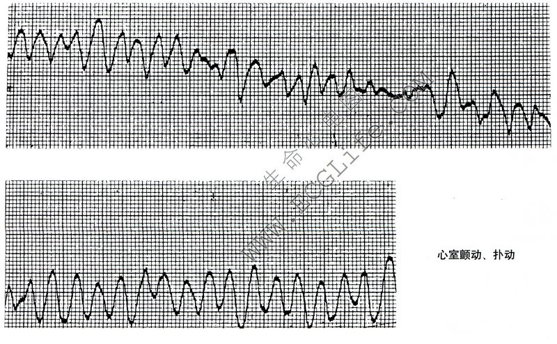 心室颤动、扑动心电图表现