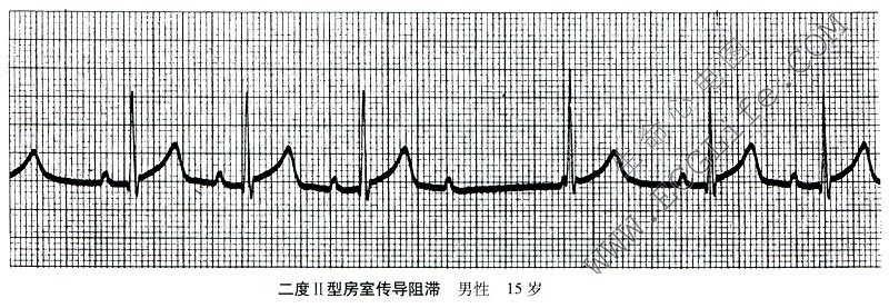 二度Ⅱ型房室传导阻滞心电图