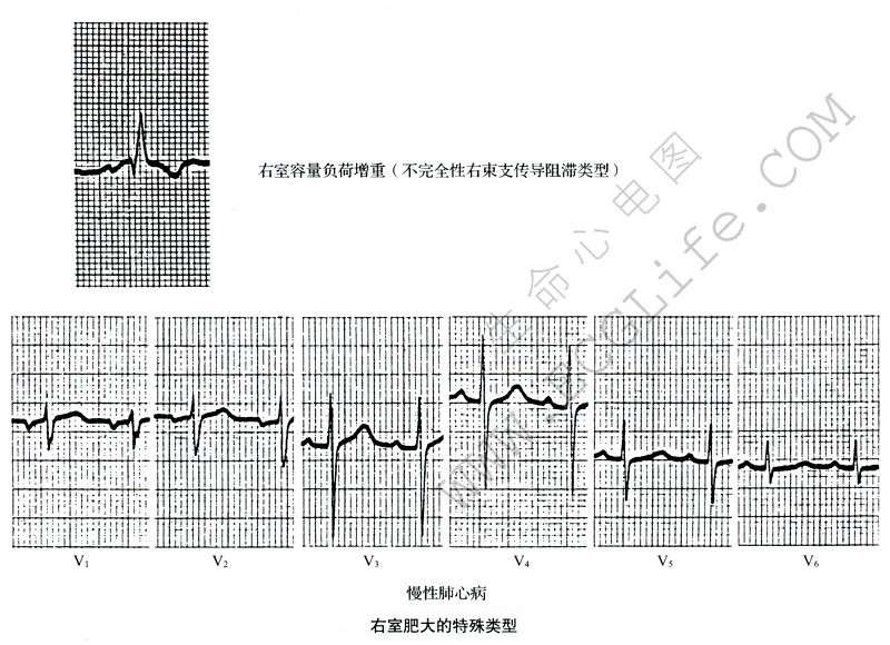 右心室肥大的特殊类型