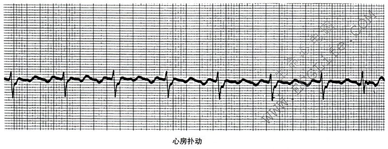 心房扑动的心电图表现