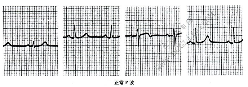 正常P波