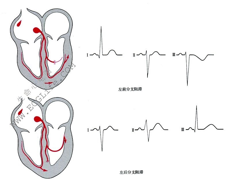 分支阻滞（心脏示意图与心电图）