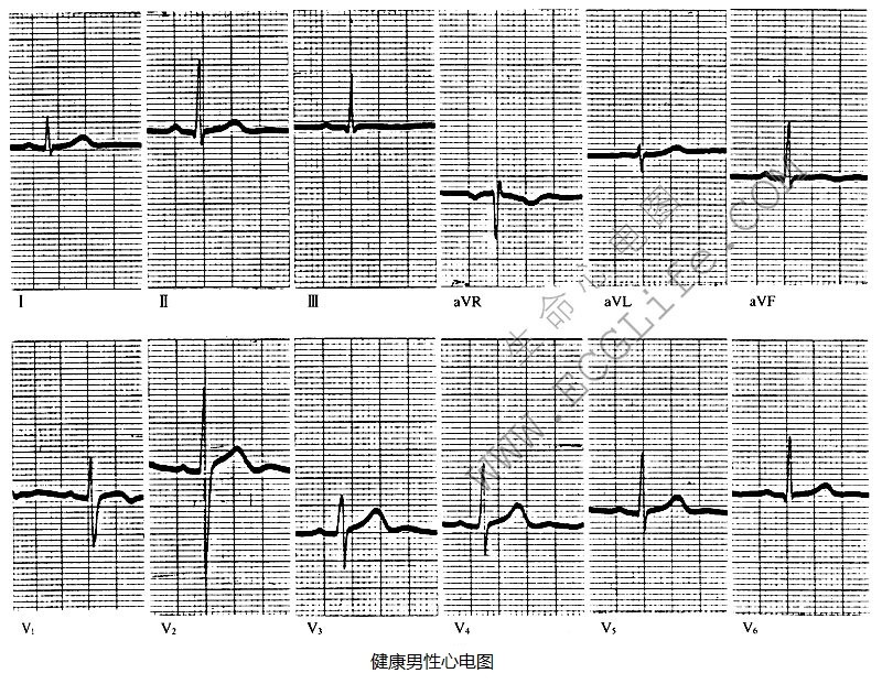 健康男性心电图