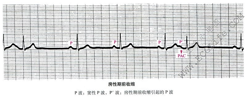 房性期前收缩心电图