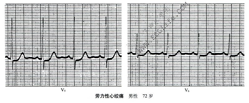 劳力性心绞痛心电图