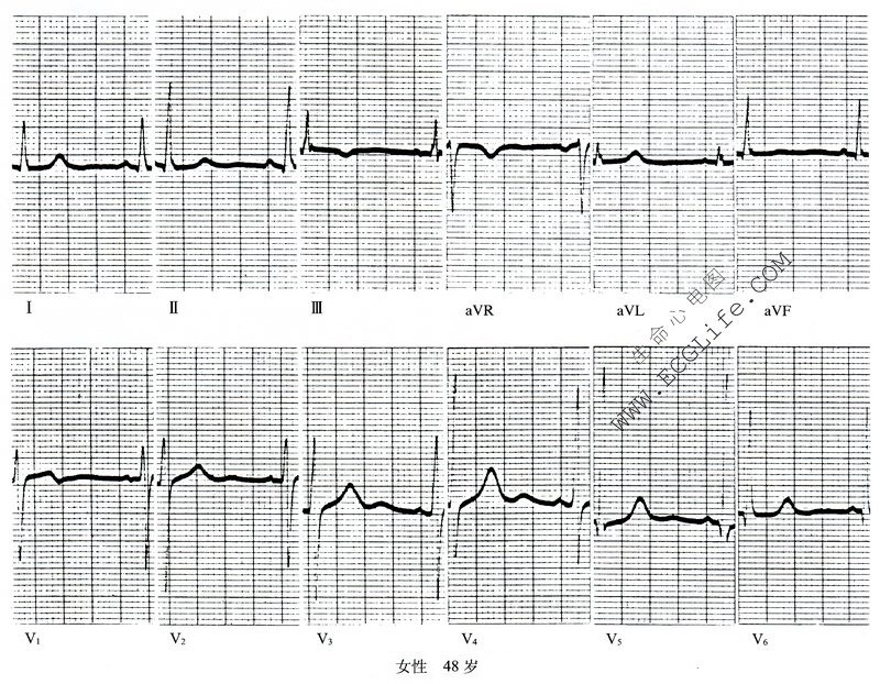 例：T波异常劳力性心绞痛心电图
