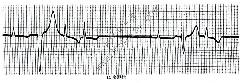 多源性（心电图）